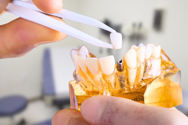 How To Extend The Life Of Your Implant Crown